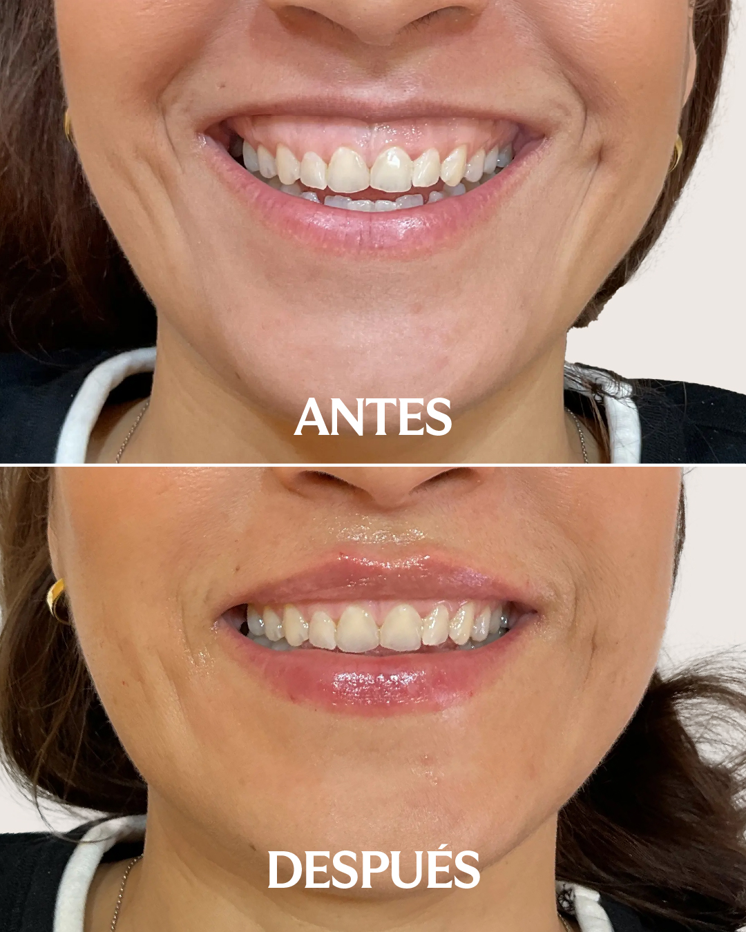 Antes y después del tratamiento de sonrisa gingival en Holaglow